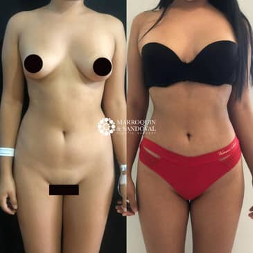 Slider image (7) Marroquin and Sandoval Plastic Surgery Guadalajara